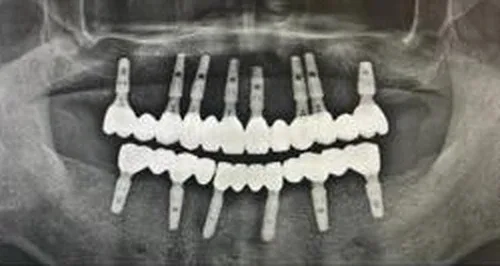 صورة بانورامية شعاعية للأسنان