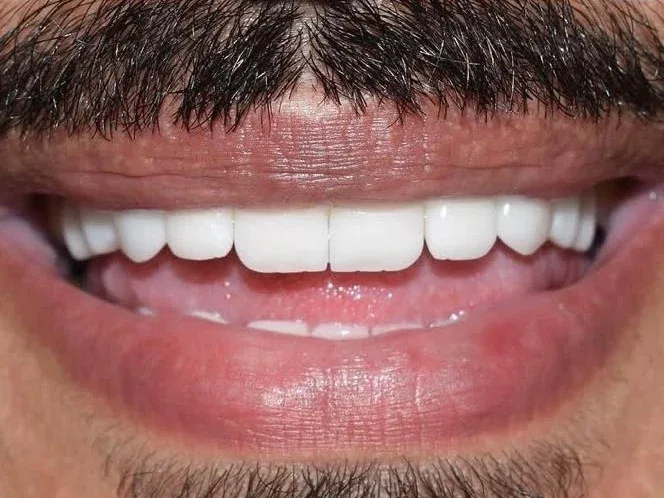 ابتسامة بأسنان بيضاء متناسقة